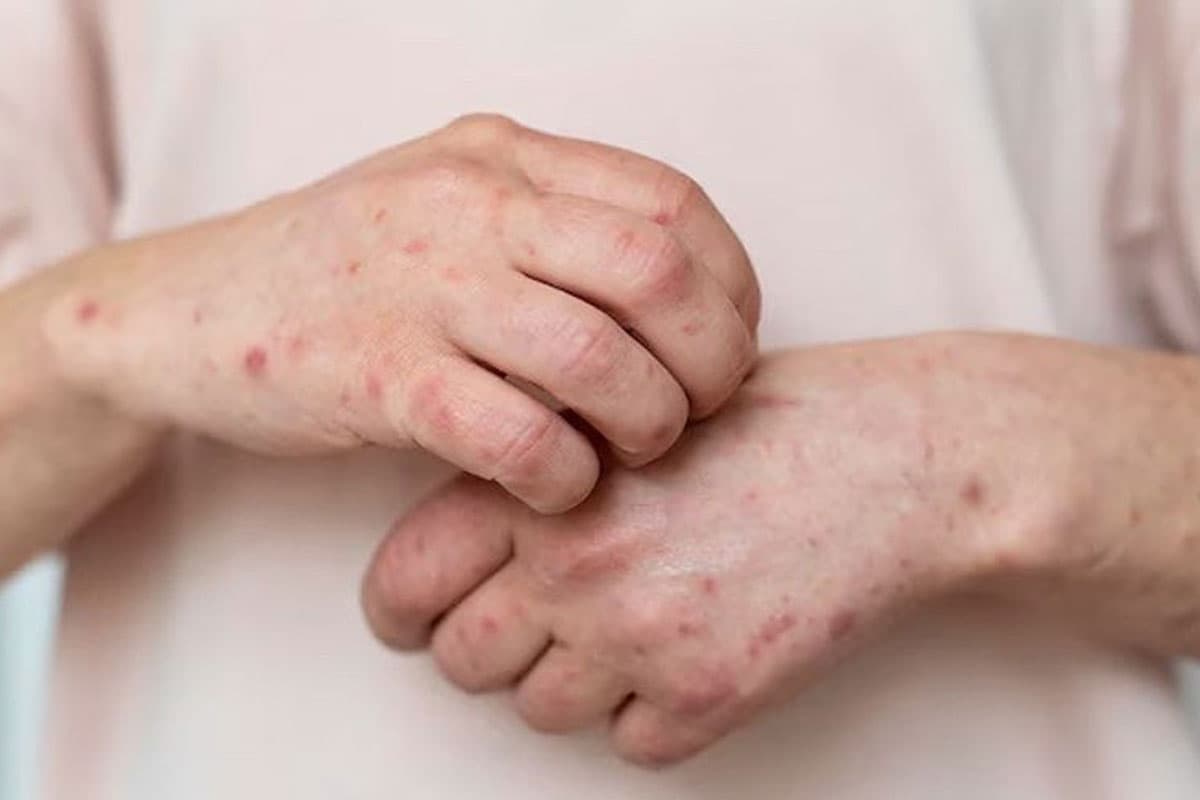 Waspada 3 Fase Campak, Ini Gejala dan Bahaya Penularannya